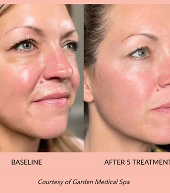 TriLift: The Advanced RF Microneedling Treatment For Non-Surgical Rejuvenation