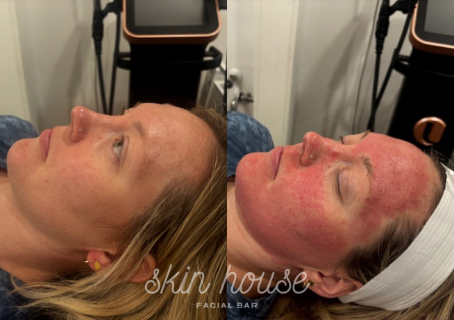SkinPen #1
