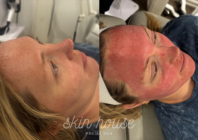 SkinPen #1