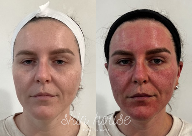 SkinPen #2