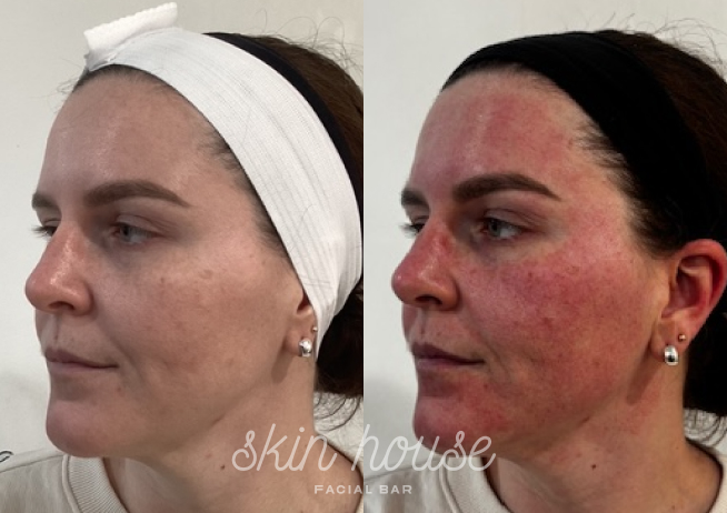 SkinPen #2