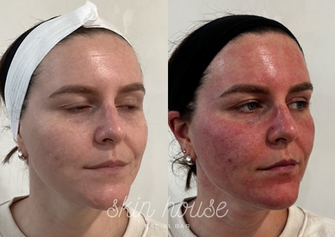 SkinPen #2
