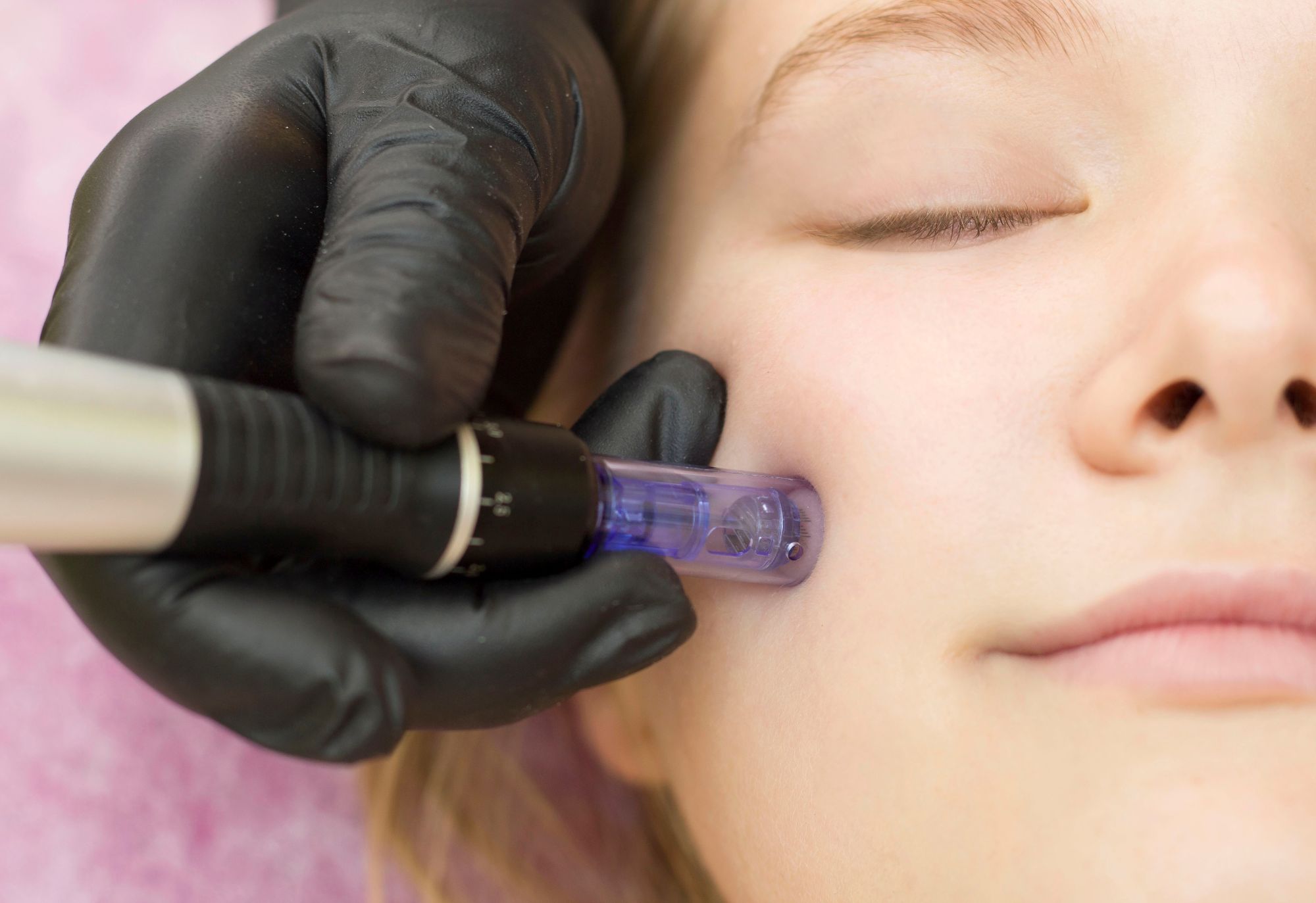 How Long Does SkinPen Microneedling Last?