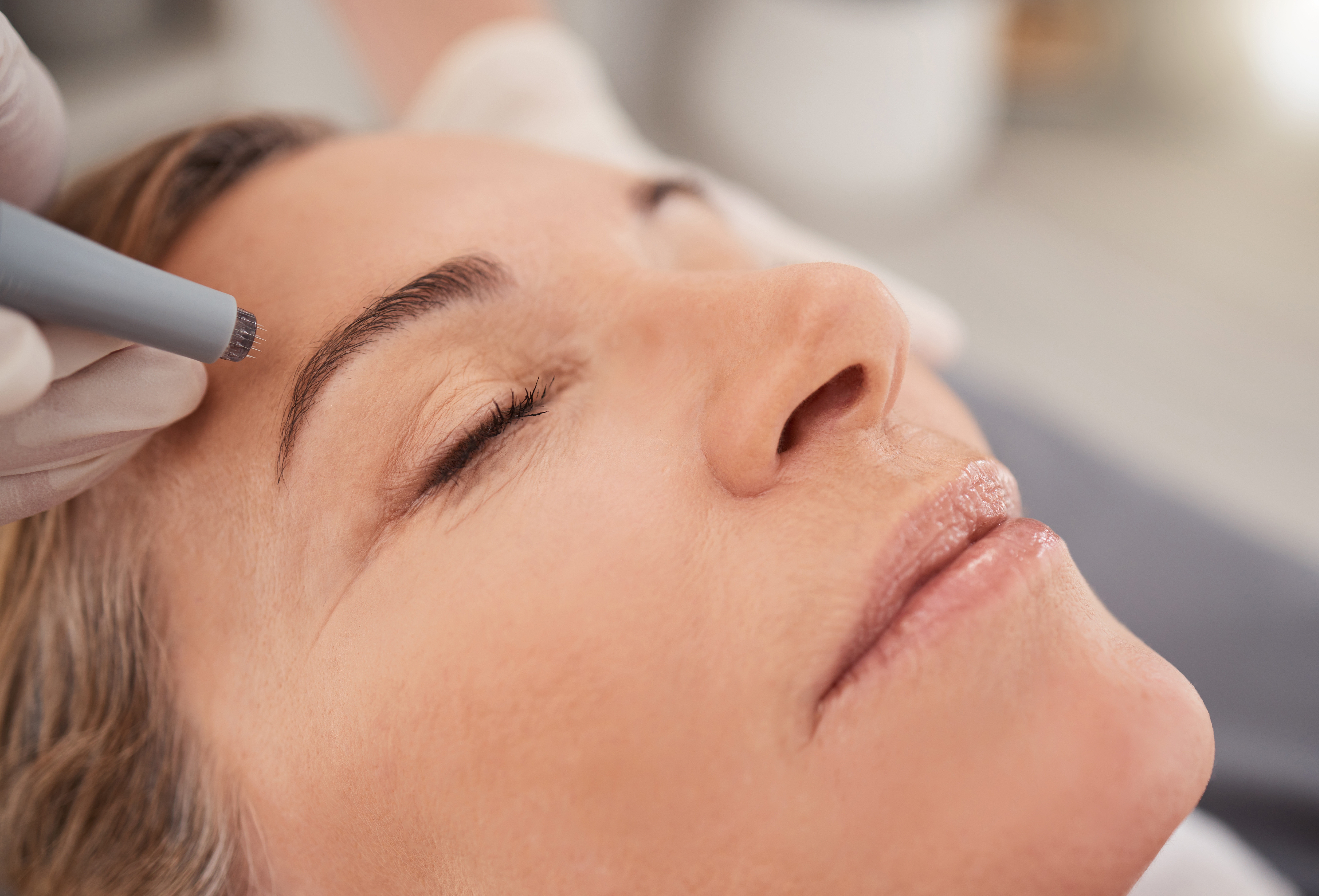 SkinPen Microneedling
